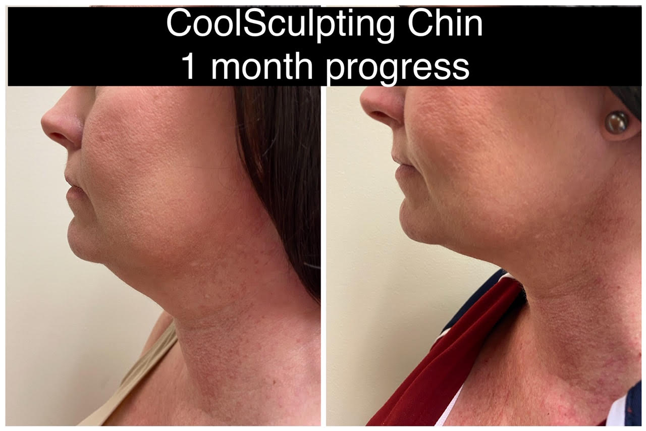 Drew Varano neck coolscupting washington dc Drew Varano neck coolscupting washington dc